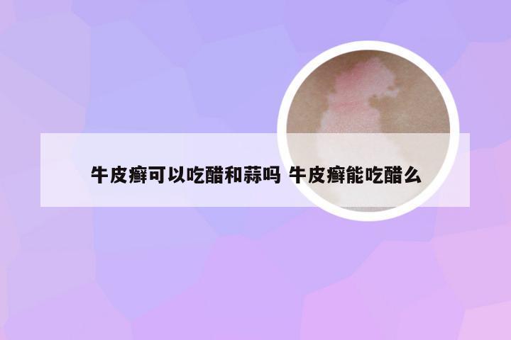 牛皮癣可以吃醋和蒜吗 牛皮癣能吃醋么