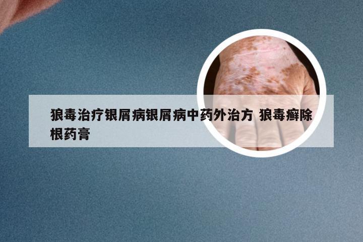 狼毒治疗银屑病银屑病中药外治方 狼毒癣除根药膏