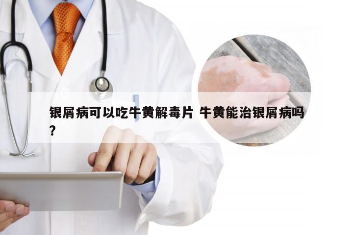银屑病可以吃牛黄解毒片 牛黄能治银屑病吗?