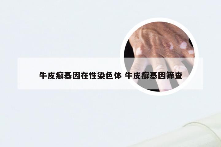 牛皮癣基因在性染色体 牛皮癣基因筛查