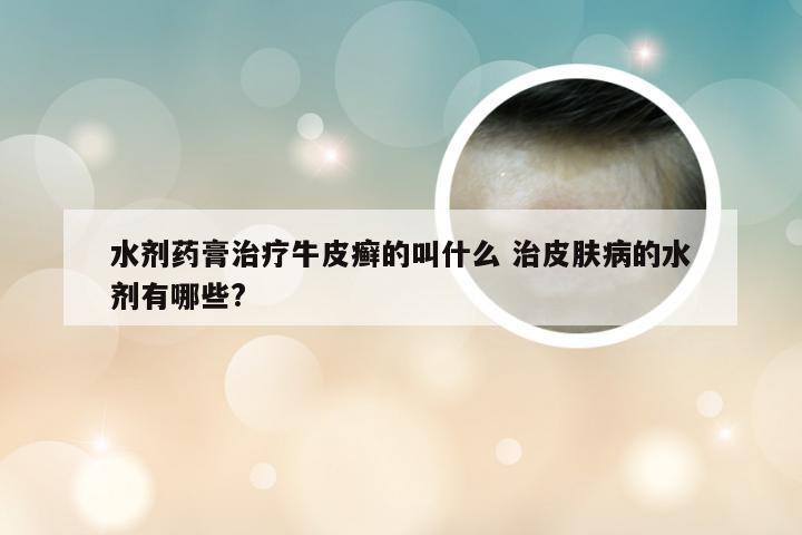 水剂药膏治疗牛皮癣的叫什么 治皮肤病的水剂有哪些?