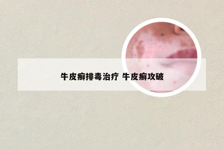 牛皮癣排毒治疗 牛皮癣攻破