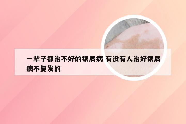 一辈子都治不好的银屑病 有没有人治好银屑病不复发的
