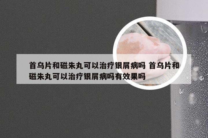 首乌片和磁朱丸可以治疗银屑病吗 首乌片和磁朱丸可以治疗银屑病吗有效果吗