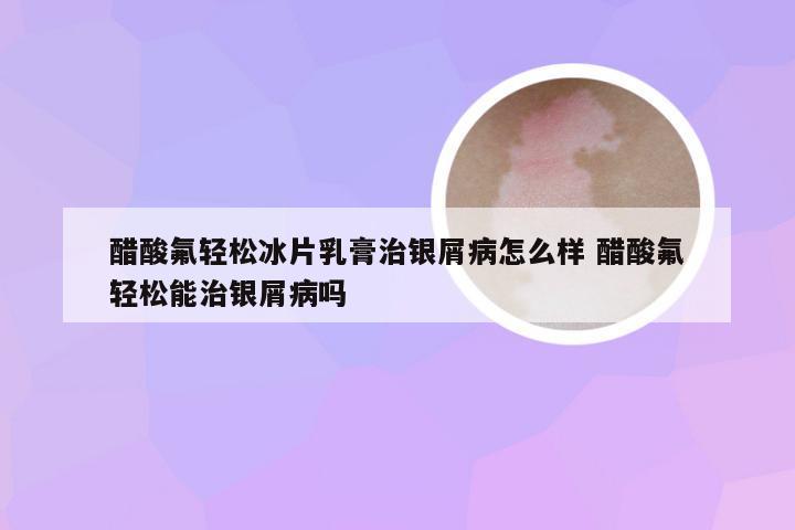 醋酸氟轻松冰片乳膏治银屑病怎么样 醋酸氟轻松能治银屑病吗