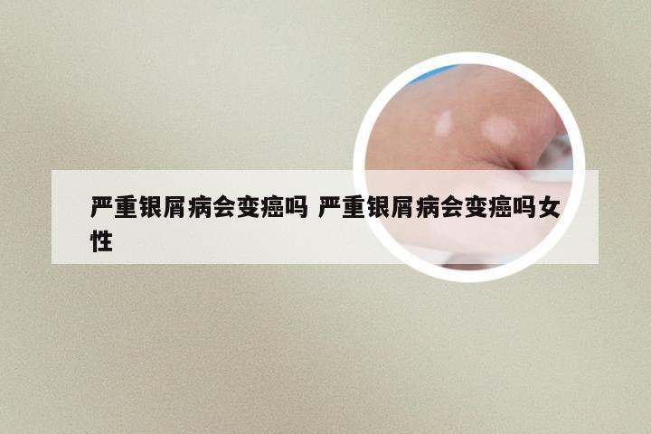 严重银屑病会变癌吗 严重银屑病会变癌吗女性