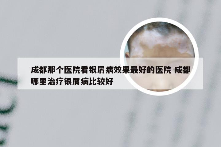成都那个医院看银屑病效果最好的医院 成都哪里治疗银屑病比较好