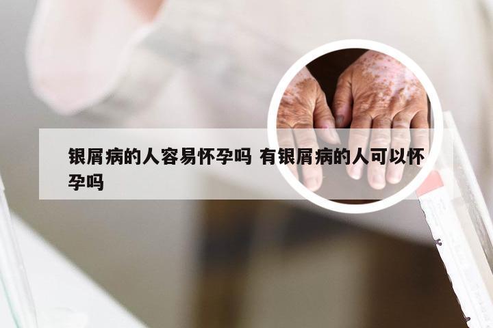 银屑病的人容易怀孕吗 有银屑病的人可以怀孕吗