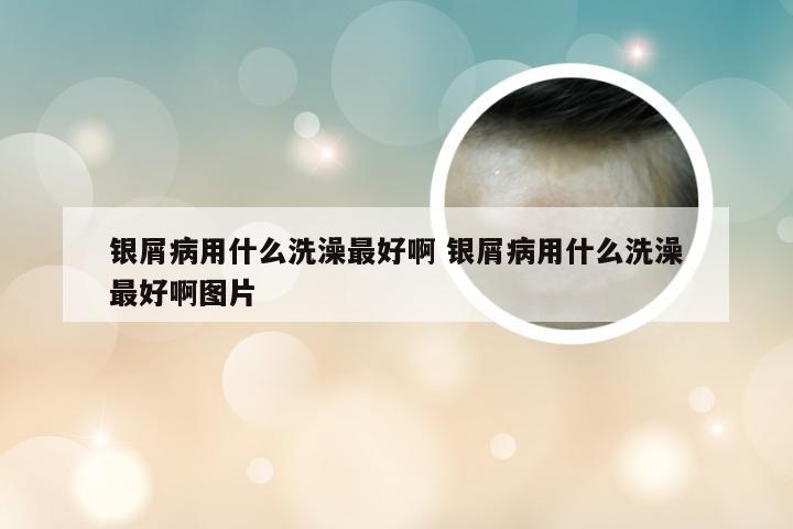 银屑病用什么洗澡最好啊 银屑病用什么洗澡最好啊图片