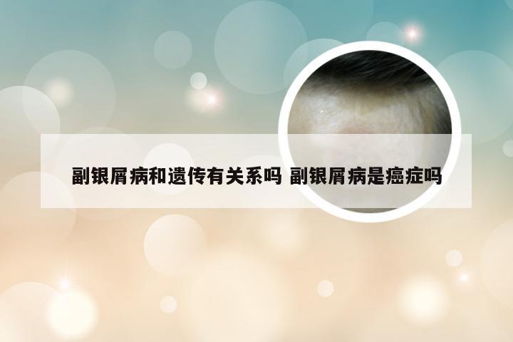 副银屑病和遗传有关系吗 副银屑病是癌症吗