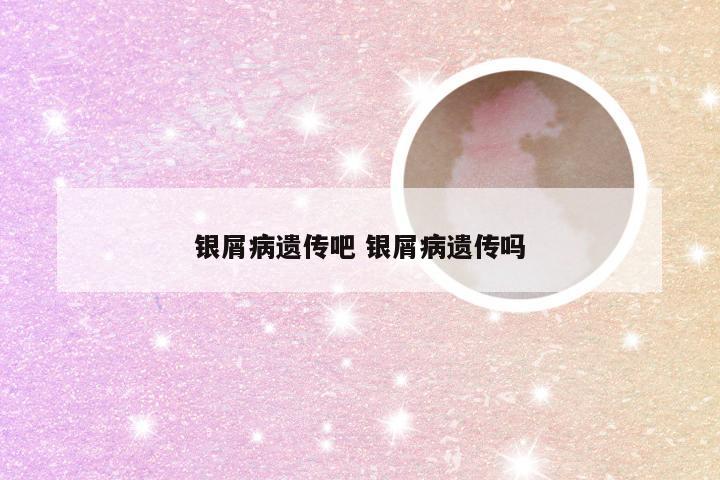 银屑病遗传吧 银屑病遗传吗