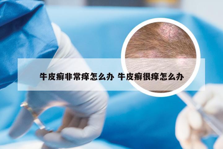 牛皮癣非常痒怎么办 牛皮癣很痒怎么办