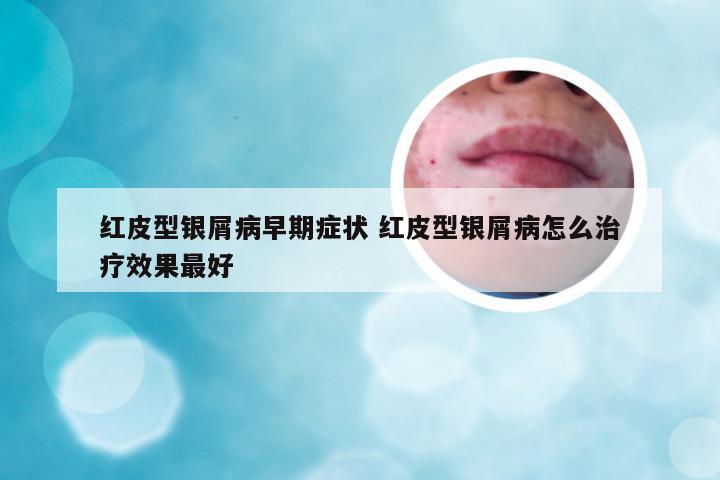 红皮型银屑病早期症状 红皮型银屑病怎么治疗效果最好