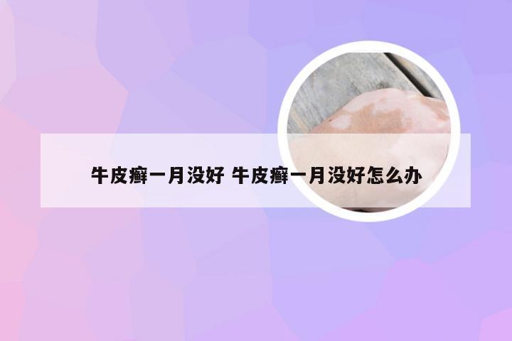 牛皮癣一月没好 牛皮癣一月没好怎么办