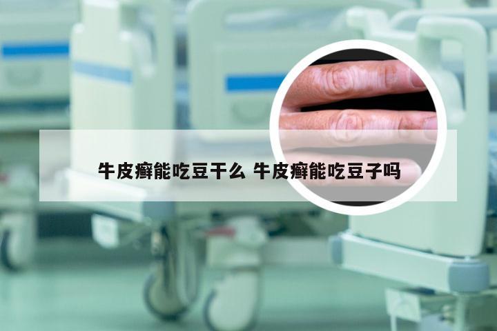 牛皮癣能吃豆干么 牛皮癣能吃豆子吗
