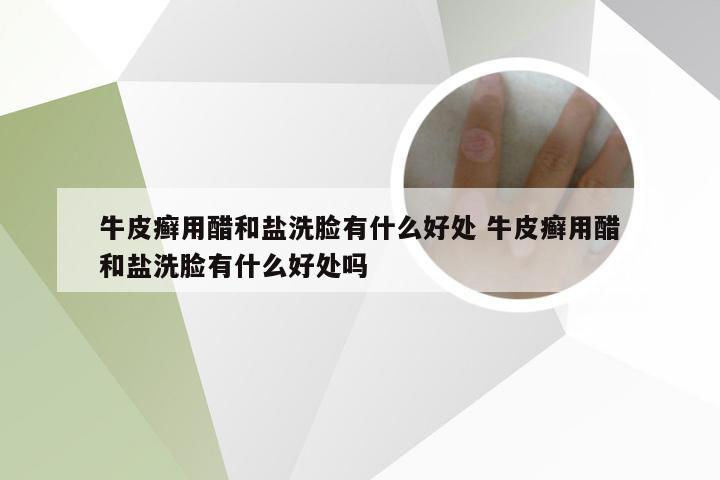 牛皮癣用醋和盐洗脸有什么好处 牛皮癣用醋和盐洗脸有什么好处吗