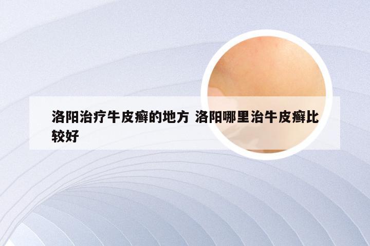 洛阳治疗牛皮癣的地方 洛阳哪里治牛皮癣比较好
