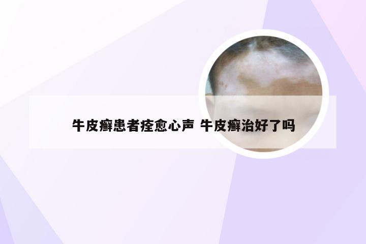牛皮癣患者痊愈心声 牛皮癣治好了吗