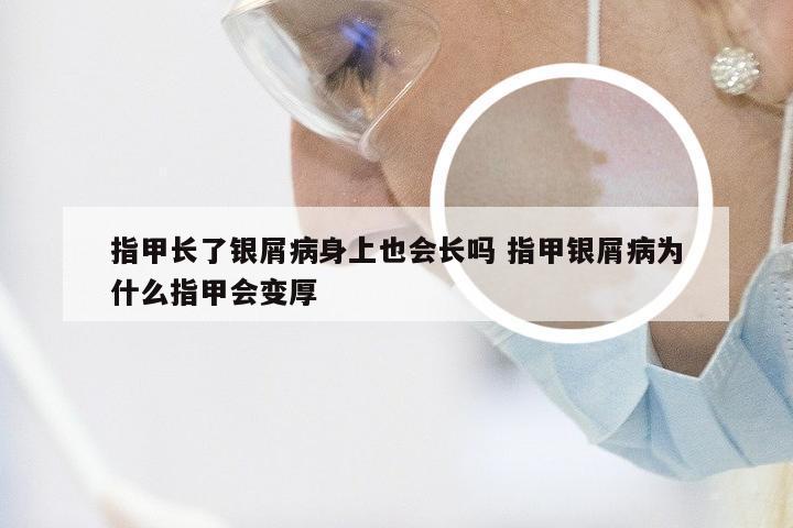 指甲长了银屑病身上也会长吗 指甲银屑病为什么指甲会变厚