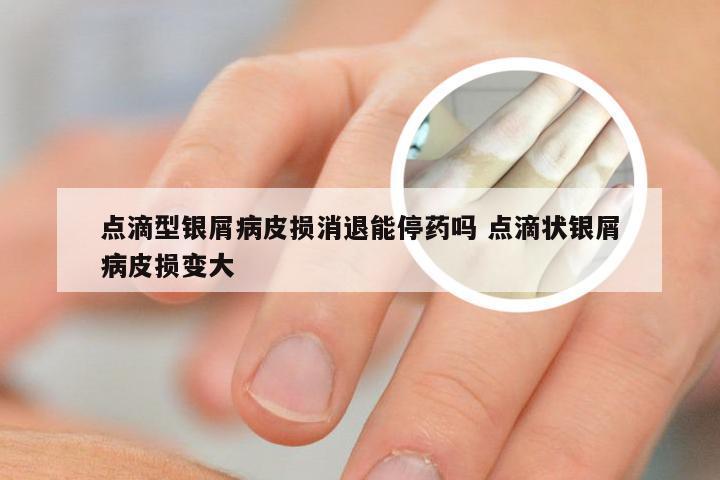 点滴型银屑病皮损消退能停药吗 点滴状银屑病皮损变大