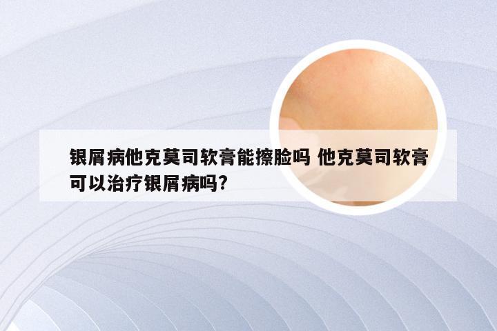 银屑病他克莫司软膏能擦脸吗 他克莫司软膏可以治疗银屑病吗?