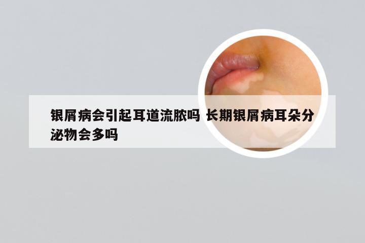 银屑病会引起耳道流脓吗 长期银屑病耳朵分泌物会多吗