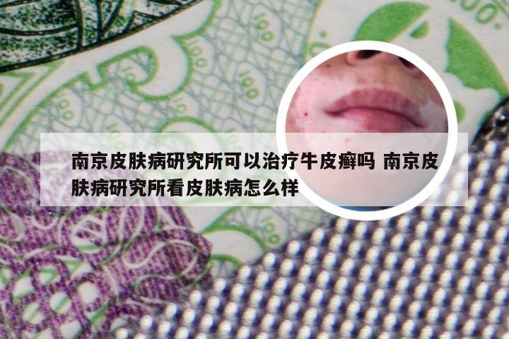 南京皮肤病研究所可以治疗牛皮癣吗 南京皮肤病研究所看皮肤病怎么样