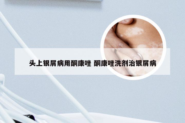 头上银屑病用酮康唑 酮康唑洗剂治银屑病