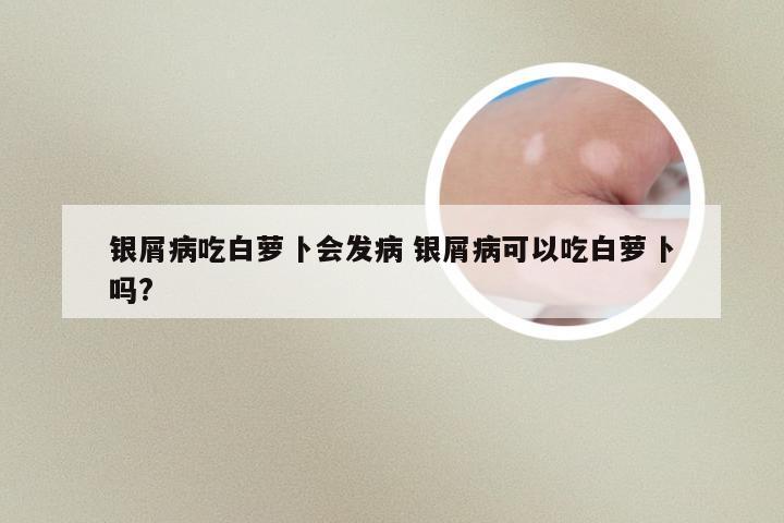 银屑病吃白萝卜会发病 银屑病可以吃白萝卜吗?