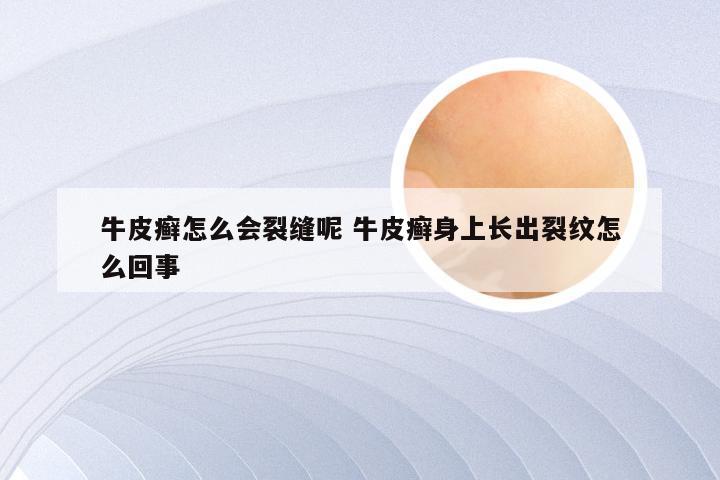 牛皮癣怎么会裂缝呢 牛皮癣身上长出裂纹怎么回事