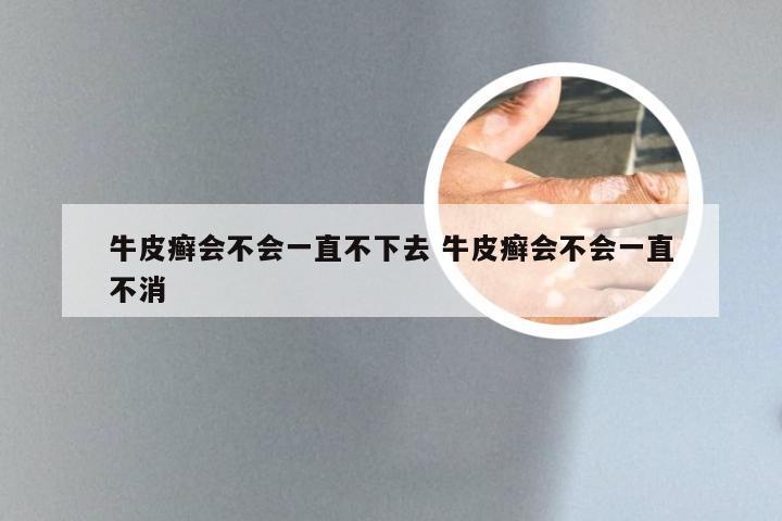 牛皮癣会不会一直不下去 牛皮癣会不会一直不消