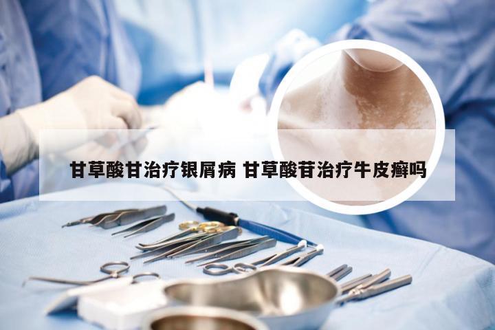 甘草酸甘治疗银屑病 甘草酸苷治疗牛皮癣吗