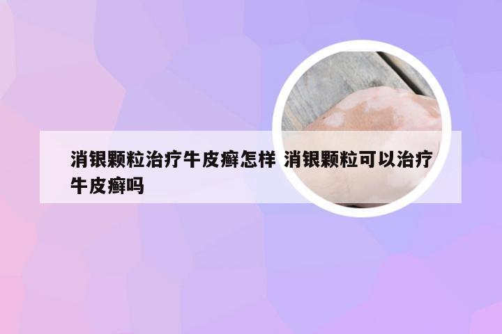 消银颗粒治疗牛皮癣怎样 消银颗粒可以治疗牛皮癣吗