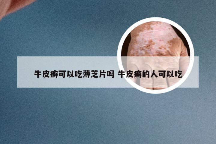 牛皮癣可以吃薄芝片吗 牛皮癣的人可以吃