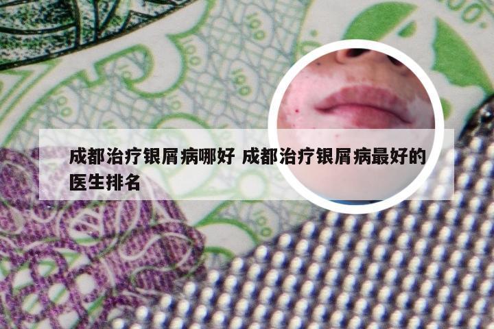 成都治疗银屑病哪好 成都治疗银屑病最好的医生排名