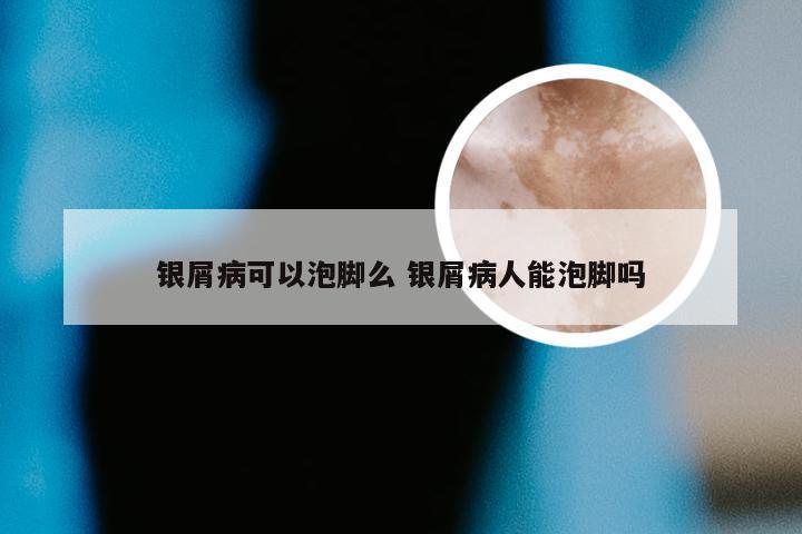 银屑病可以泡脚么 银屑病人能泡脚吗