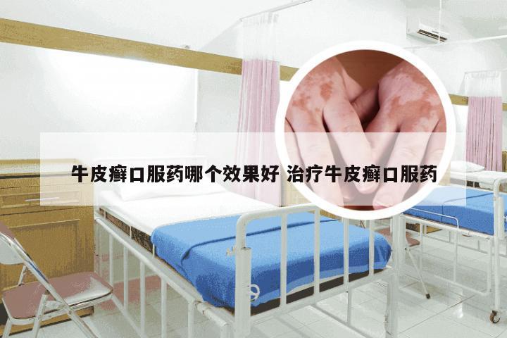 牛皮癣口服药哪个效果好 治疗牛皮癣口服药