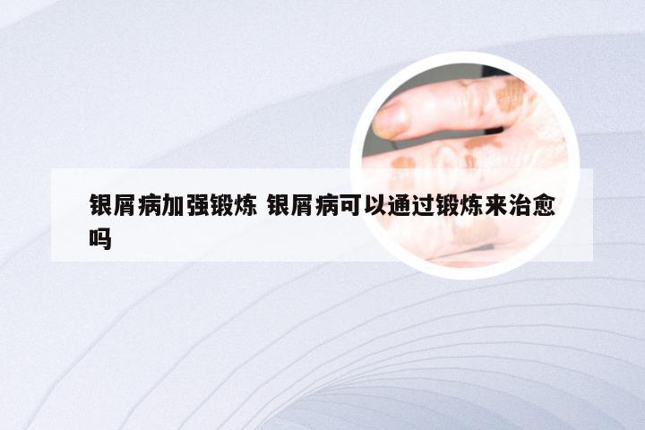 银屑病加强锻炼 银屑病可以通过锻炼来治愈吗