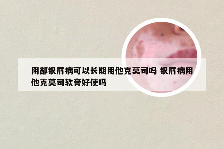 阴部银屑病可以长期用他克莫司吗 银屑病用他克莫司软膏好使吗