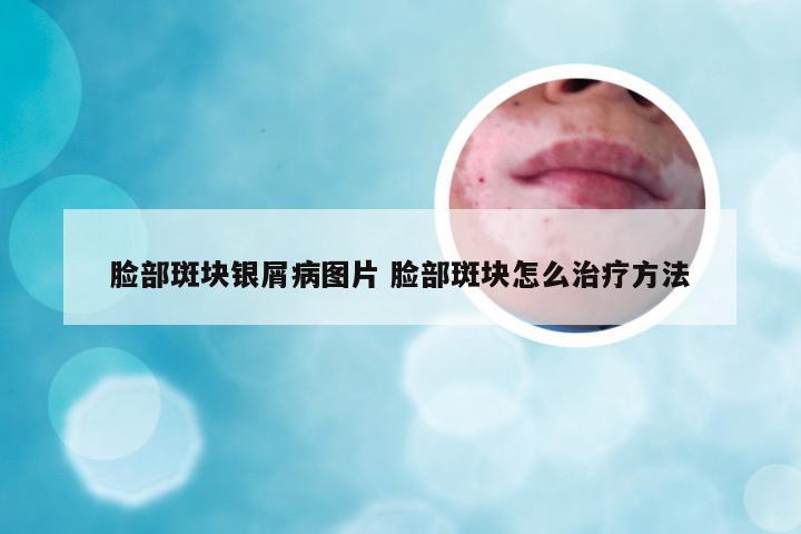 脸部斑块银屑病图片 脸部斑块怎么治疗方法