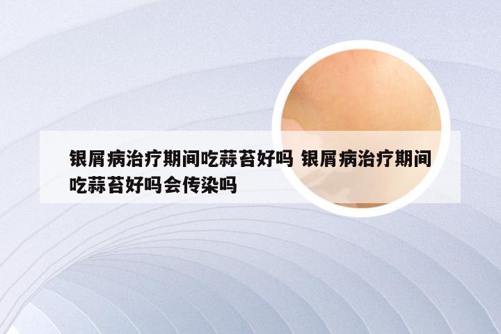 银屑病治疗期间吃蒜苔好吗 银屑病治疗期间吃蒜苔好吗会传染吗