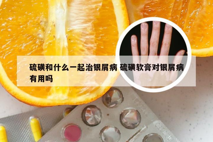 硫磺和什么一起治银屑病 硫磺软膏对银屑病有用吗