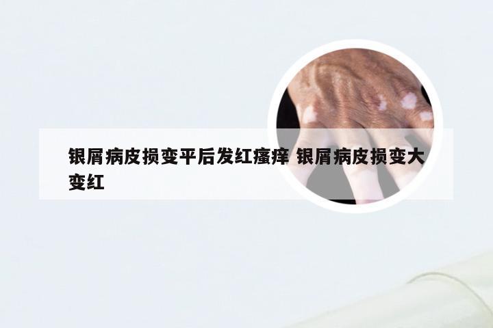 银屑病皮损变平后发红瘙痒 银屑病皮损变大变红