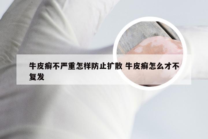 牛皮癣不严重怎样防止扩散 牛皮癣怎么才不复发