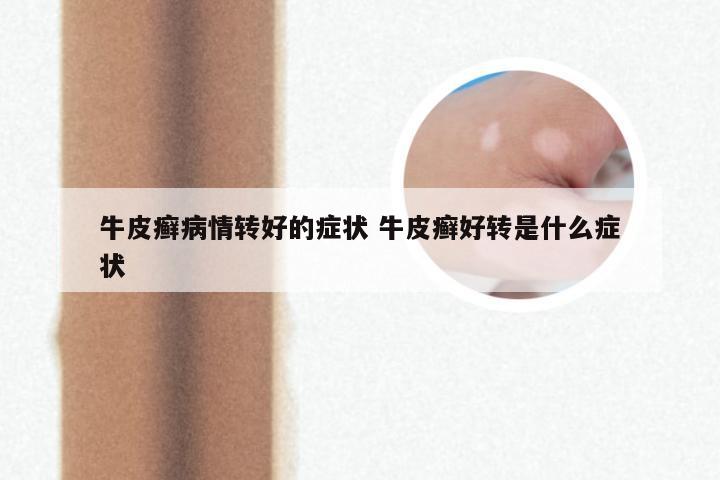牛皮癣病情转好的症状 牛皮癣好转是什么症状