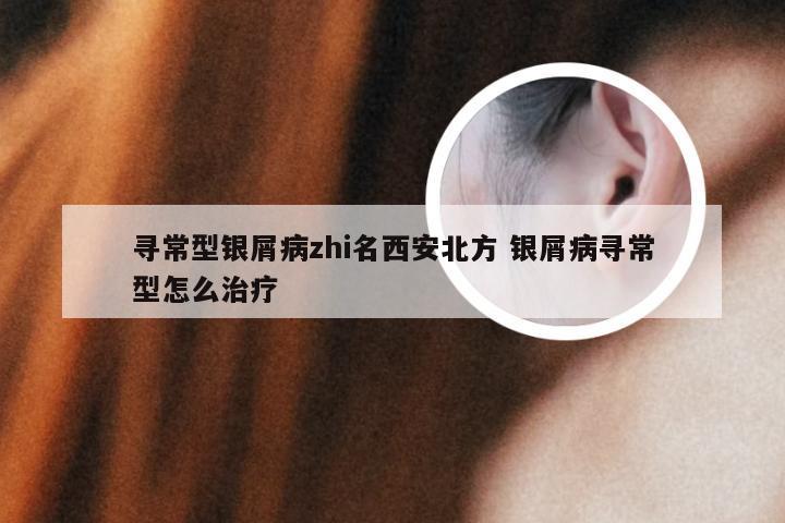 寻常型银屑病zhi名西安北方 银屑病寻常型怎么治疗