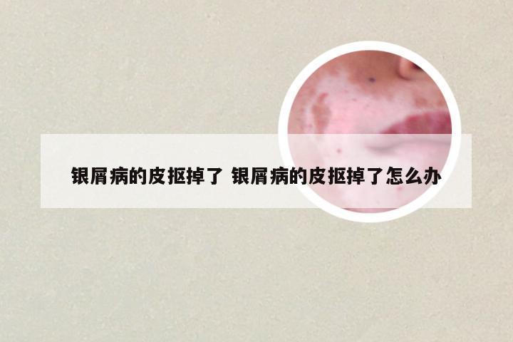 银屑病的皮抠掉了 银屑病的皮抠掉了怎么办