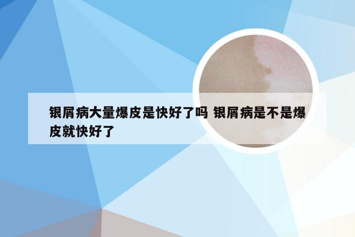 银屑病大量爆皮是快好了吗 银屑病是不是爆皮就快好了