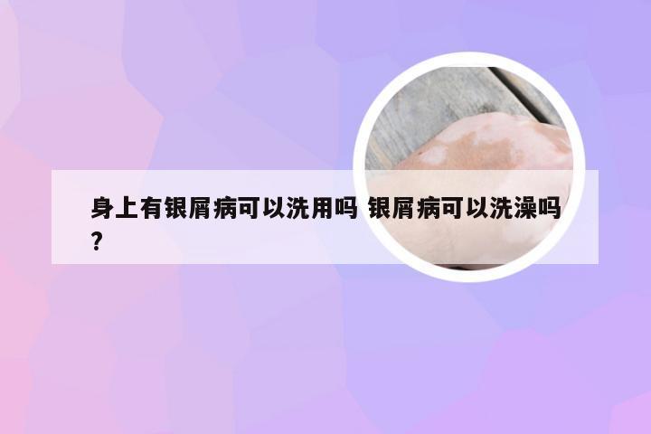 身上有银屑病可以洗用吗 银屑病可以洗澡吗?