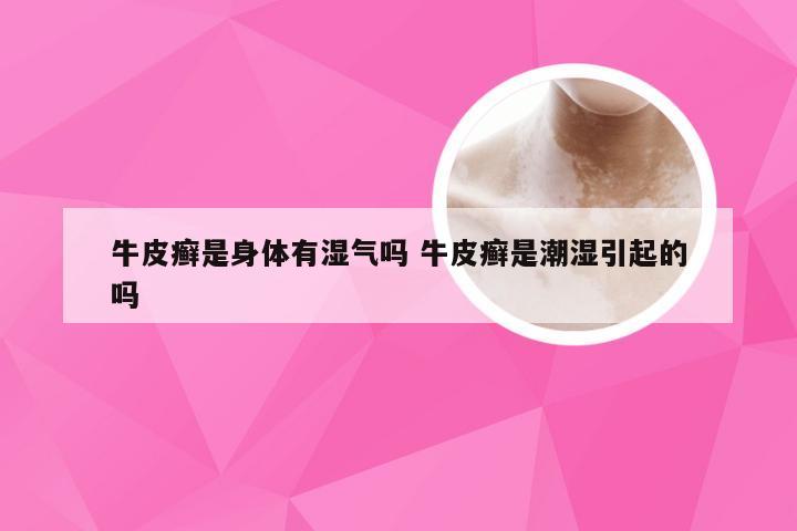 牛皮癣是身体有湿气吗 牛皮癣是潮湿引起的吗